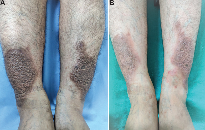 (A) Symmetrical, brown plaques with peau-d' orange appearance over bilateral lower legs suggestive of pretibial myxoedema. (B) Post-treatment image showing a remarkable reduction in the thickness of the plaques and improvement in texture.